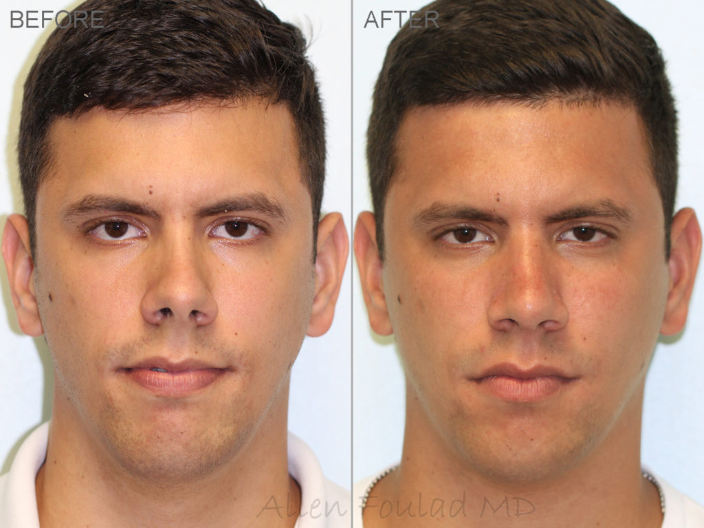 Before and after primary rhinoplasty (nose job for men).
