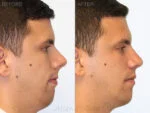 Before & After (id-1005) – Rhinoplasty