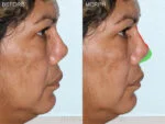Before & After (id-1004) – Rhinoplasty (Revision)