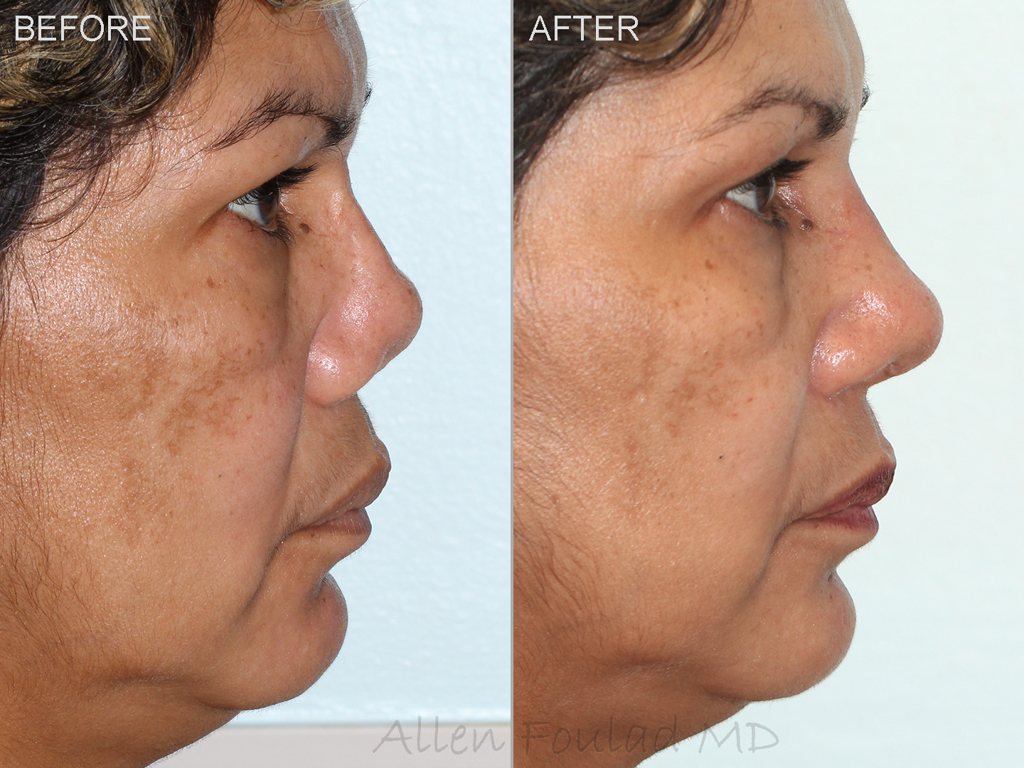 Before and after revision rhinoplasty using costal cartilage.