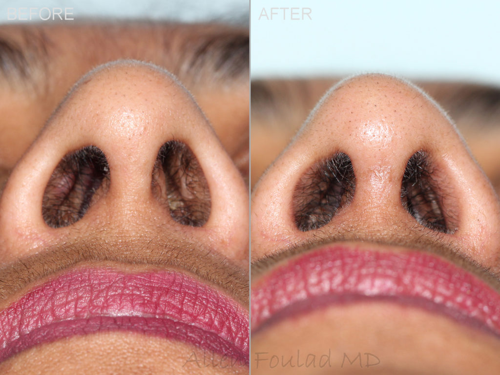 Before and after revision rhinoplasty. Base view shows a more open nasal airway after treating the collapse.