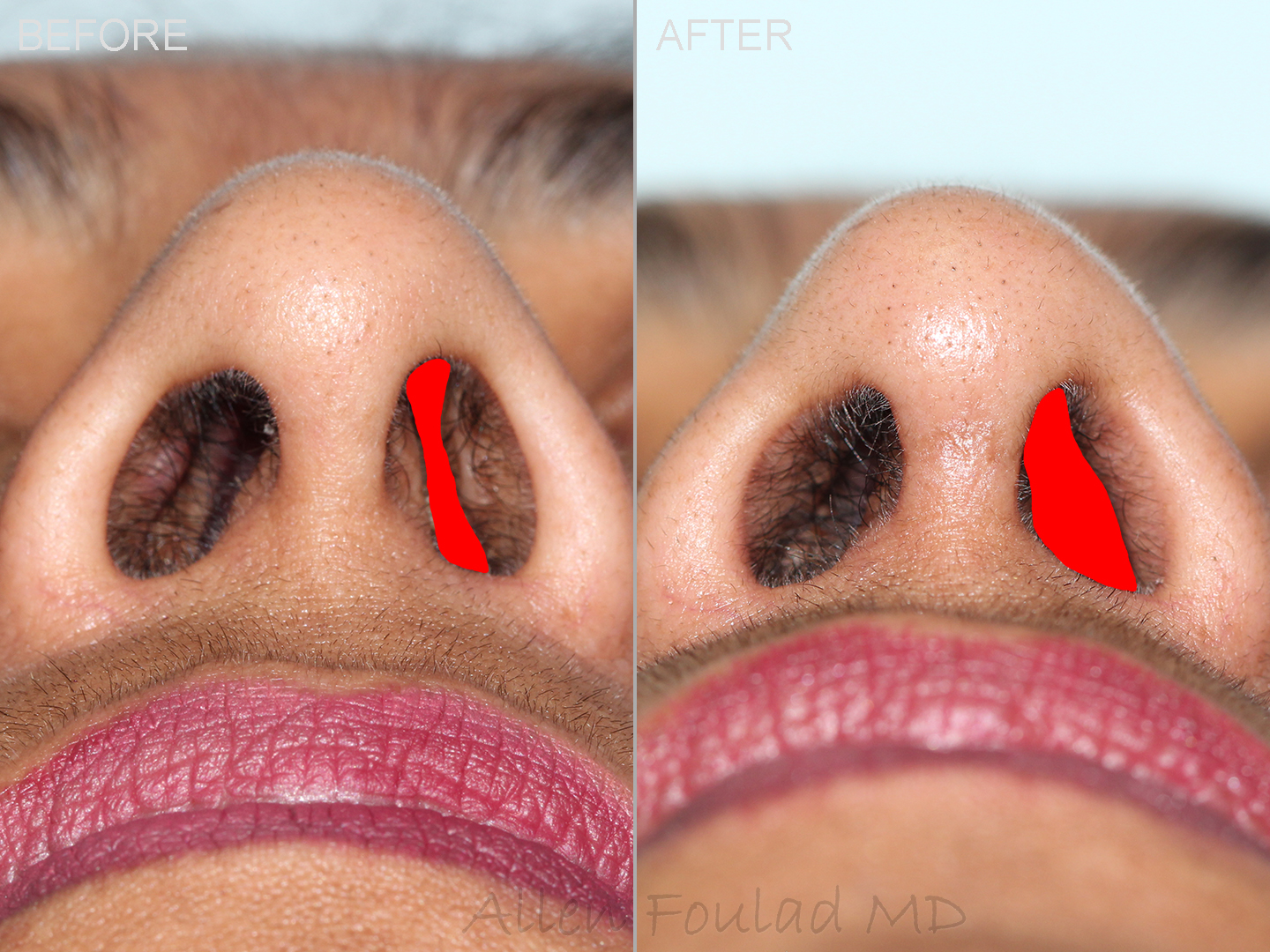 RHINOPLASTY (NOSE JOB)