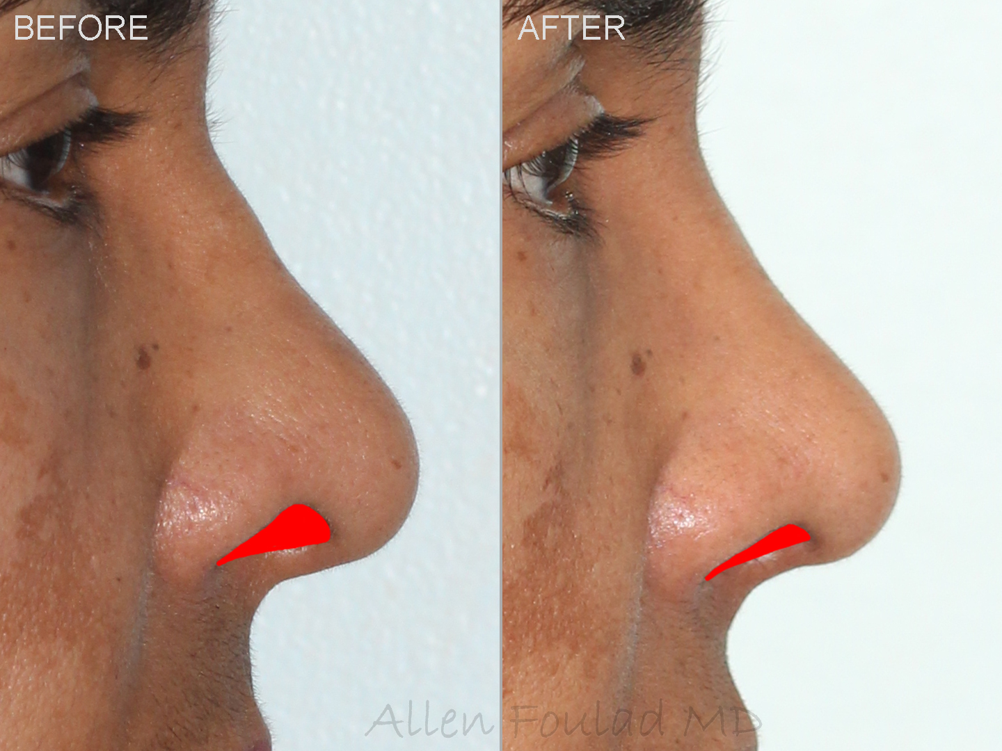 RHINOPLASTY (NOSE JOB)