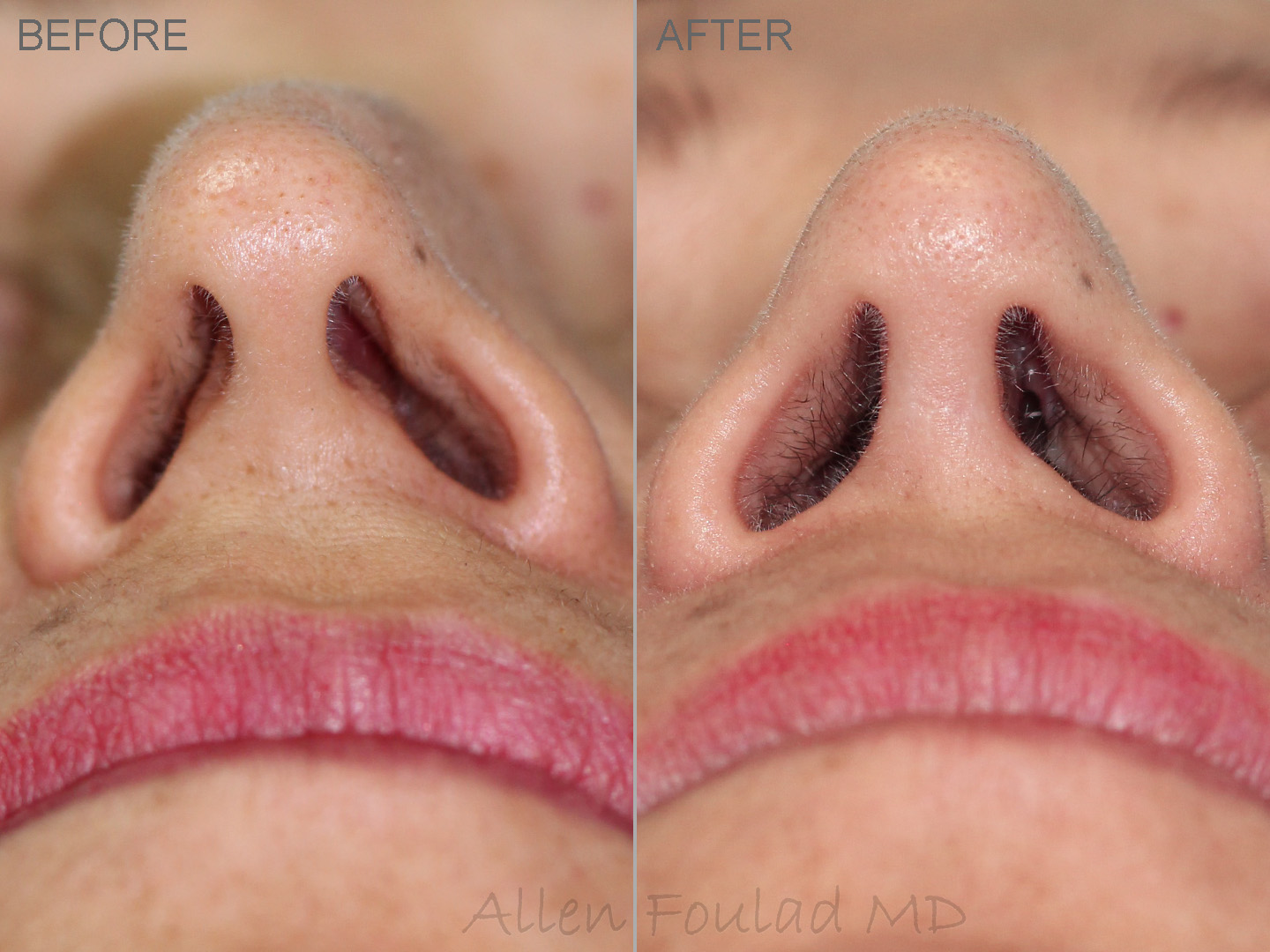Before and after rhinoplasty and septoplasty. Base view illustrates how much the airway has opened after straightening the nose and septum.
