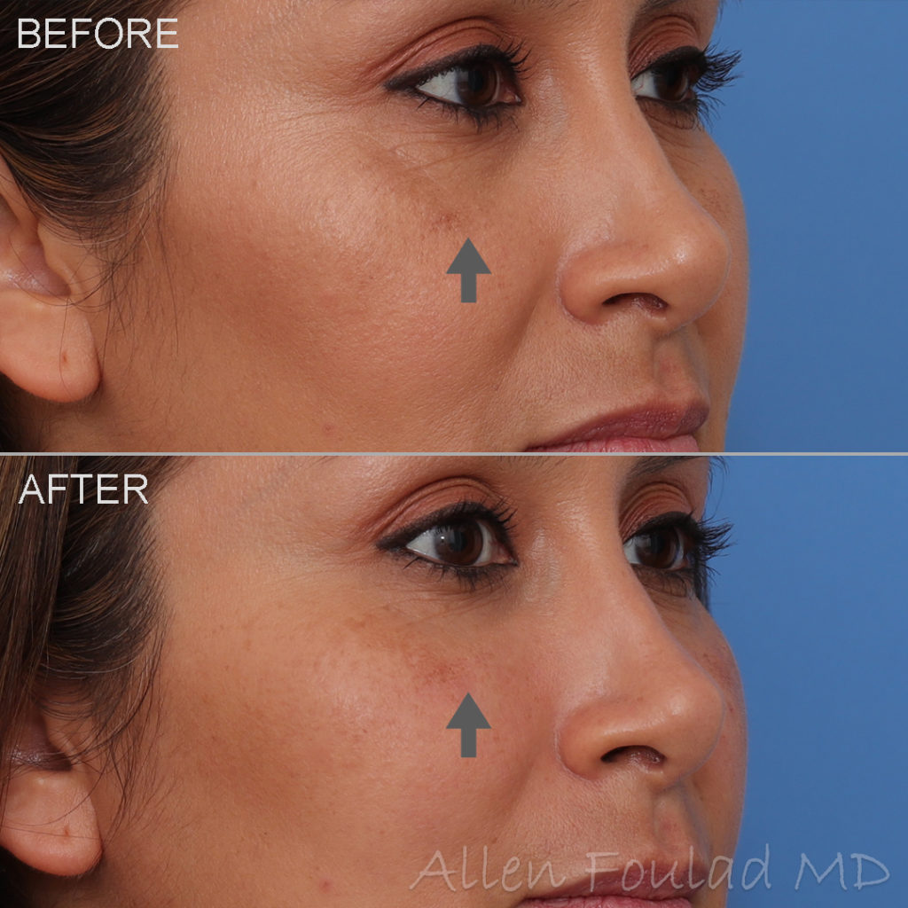 Before and after tear trough and anterior cheek filler treatment. Under eye contour improved, cheek raised, and nasolabial fold softened.