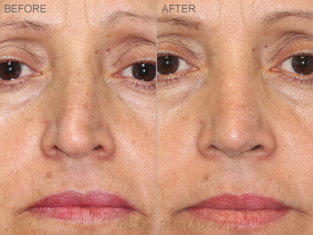 Before & After (id-1002) – Rhinoplasty (Trauma) Before and after rhinoplasty and septoplasty (nose job) to straighten a crooked nose after trauma.