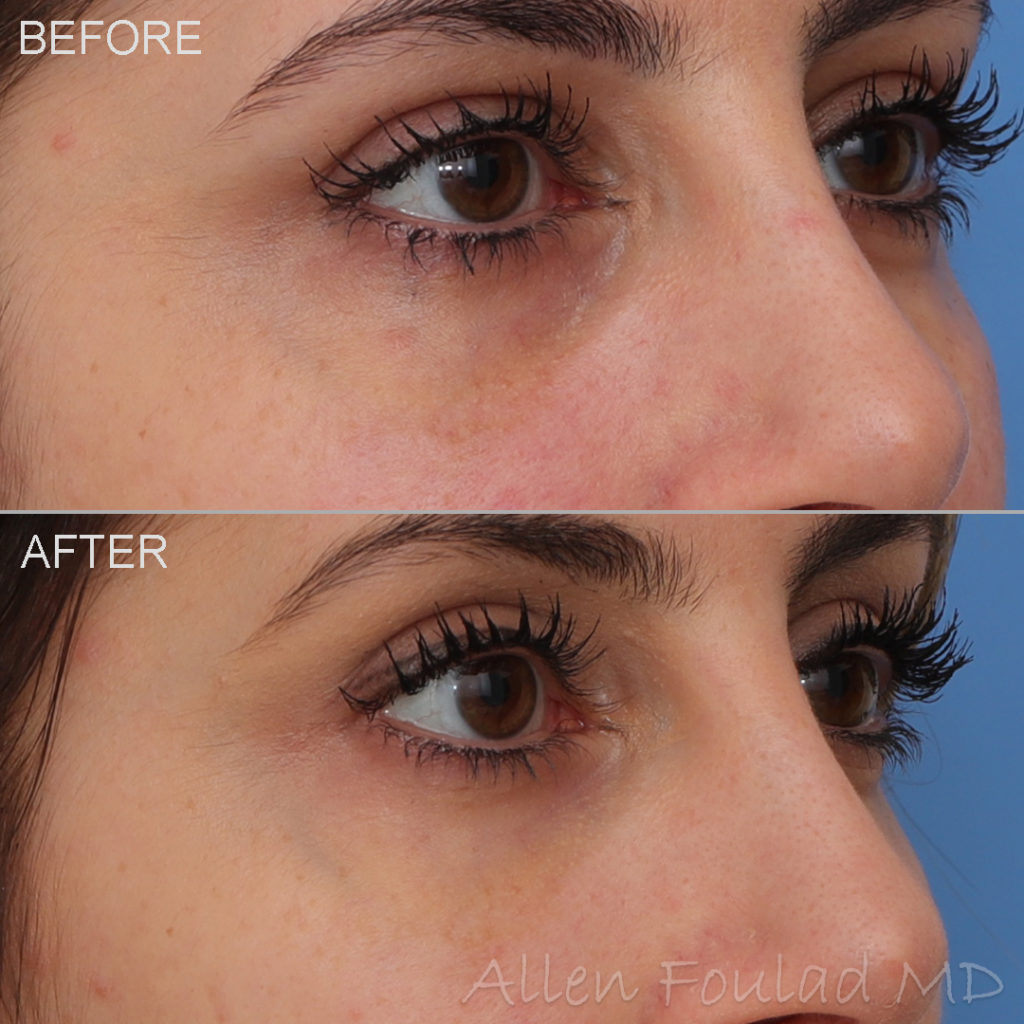Before and after tear trough filler treatment. Under eye hollows have been filled and softened in woman with thin skin.