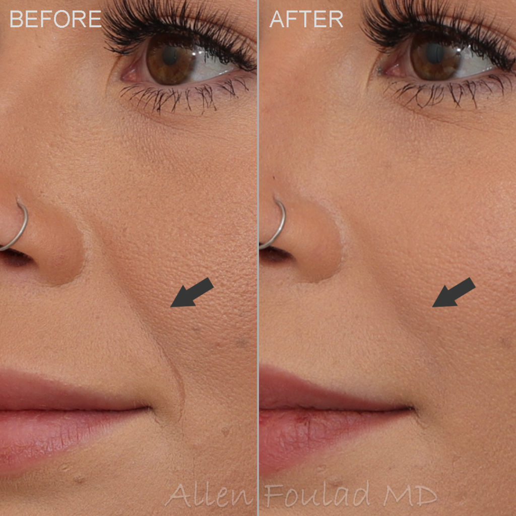 Before and after smile line filler treatment. Laugh lines have been reduced in young woman.