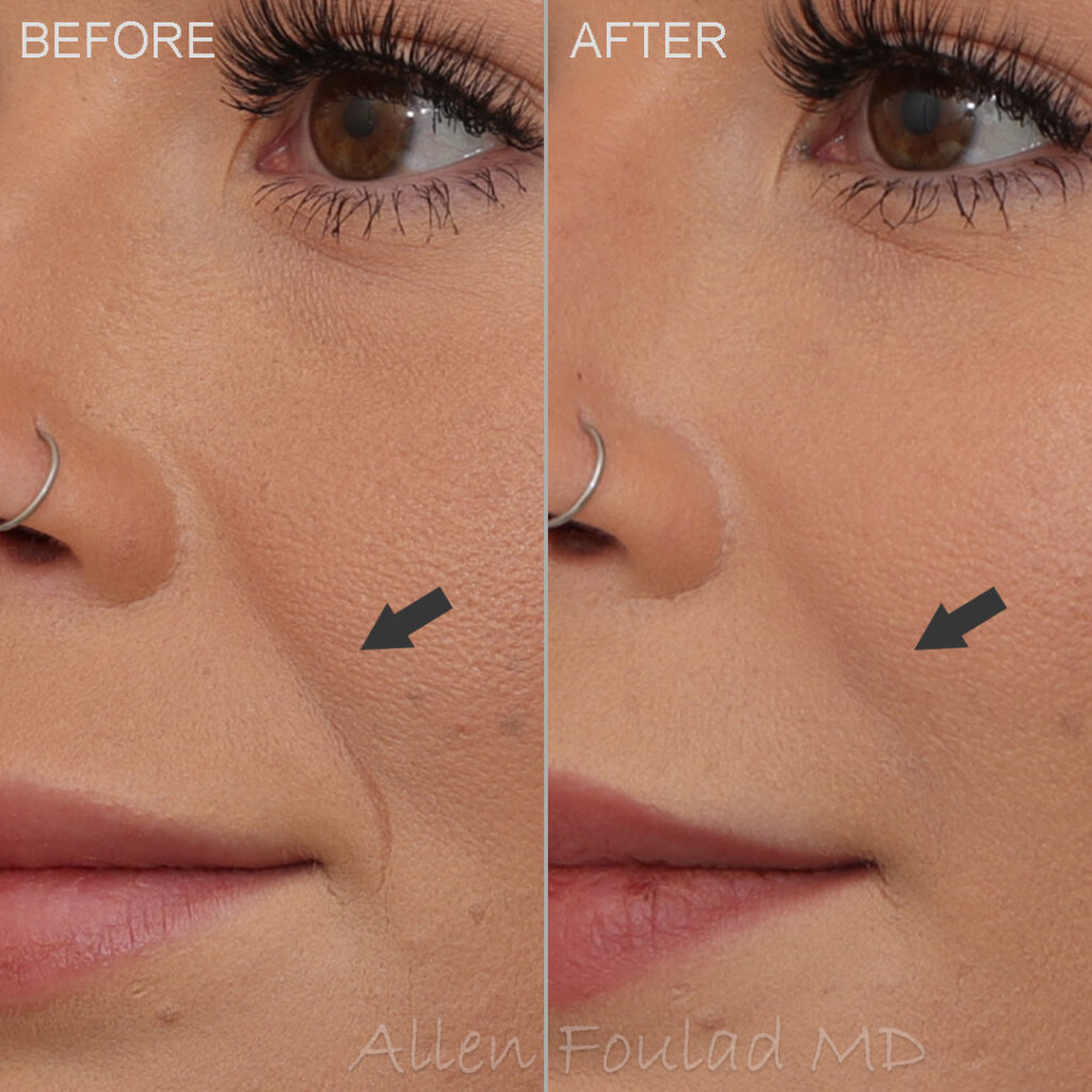Before & After (id-1010) – Fillers (Nasolabial Fold) Before and after smile line filler treatment. Laugh lines have been reduced in young woman.