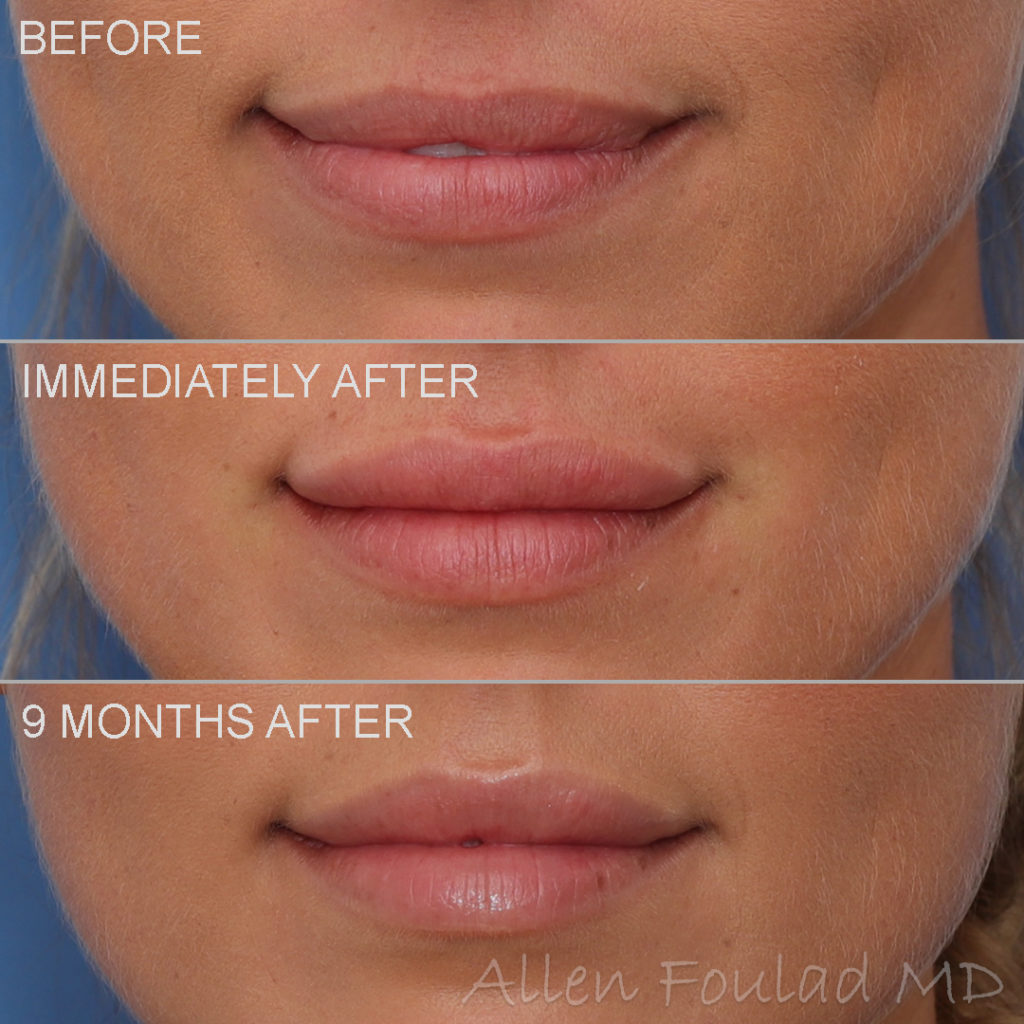Before and after lip filler treatment. Contour of the lip is improved and size of the lip enhanced.