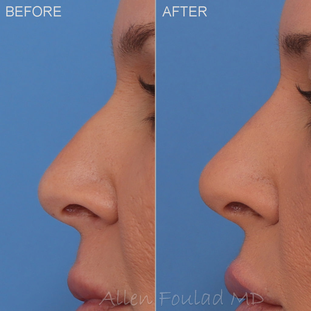 Before and after filler treatment. Contour of the nose is straightened.
