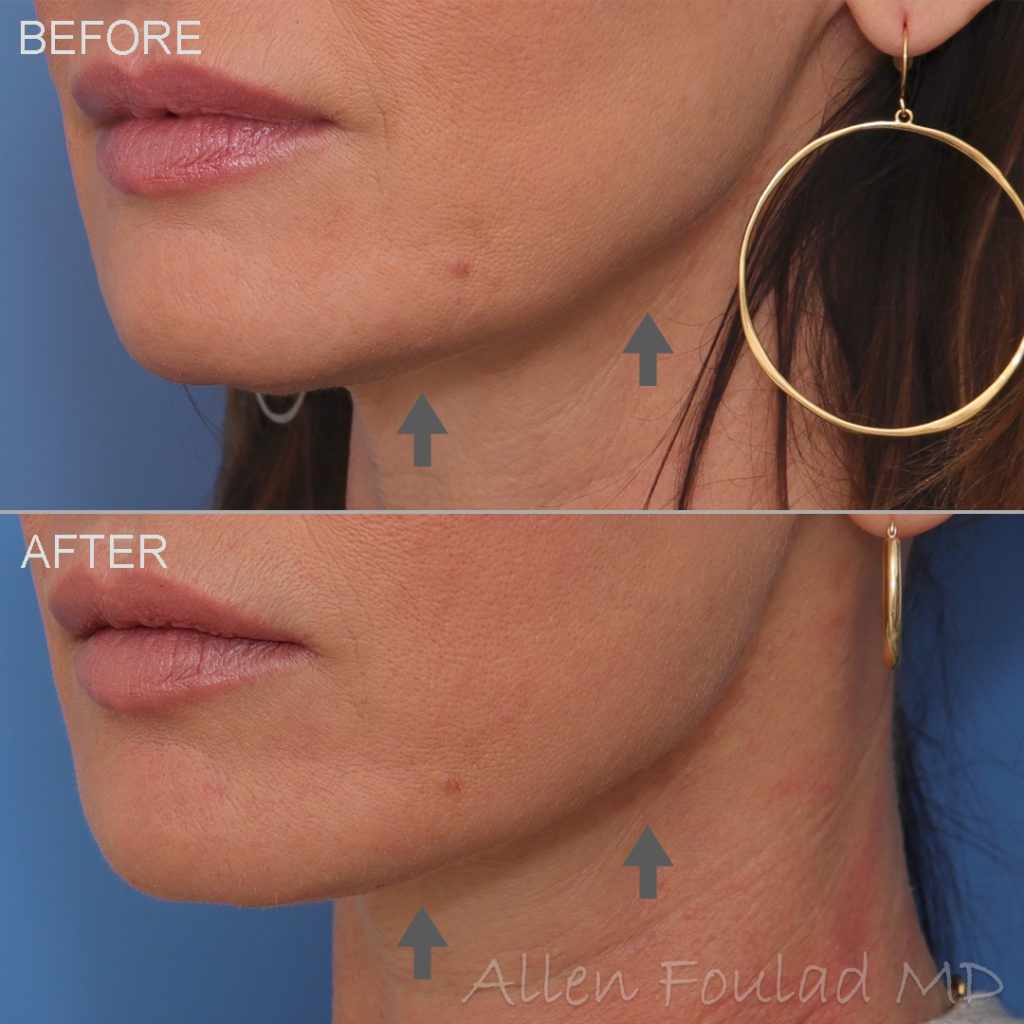 Before and after jawline filler treatment. Jawline contour improved and appearance of jowls softened in young woman.