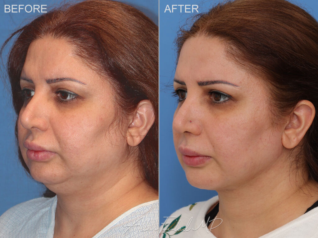 Before and after neck and jowl liposuction. Jawline definition improved.