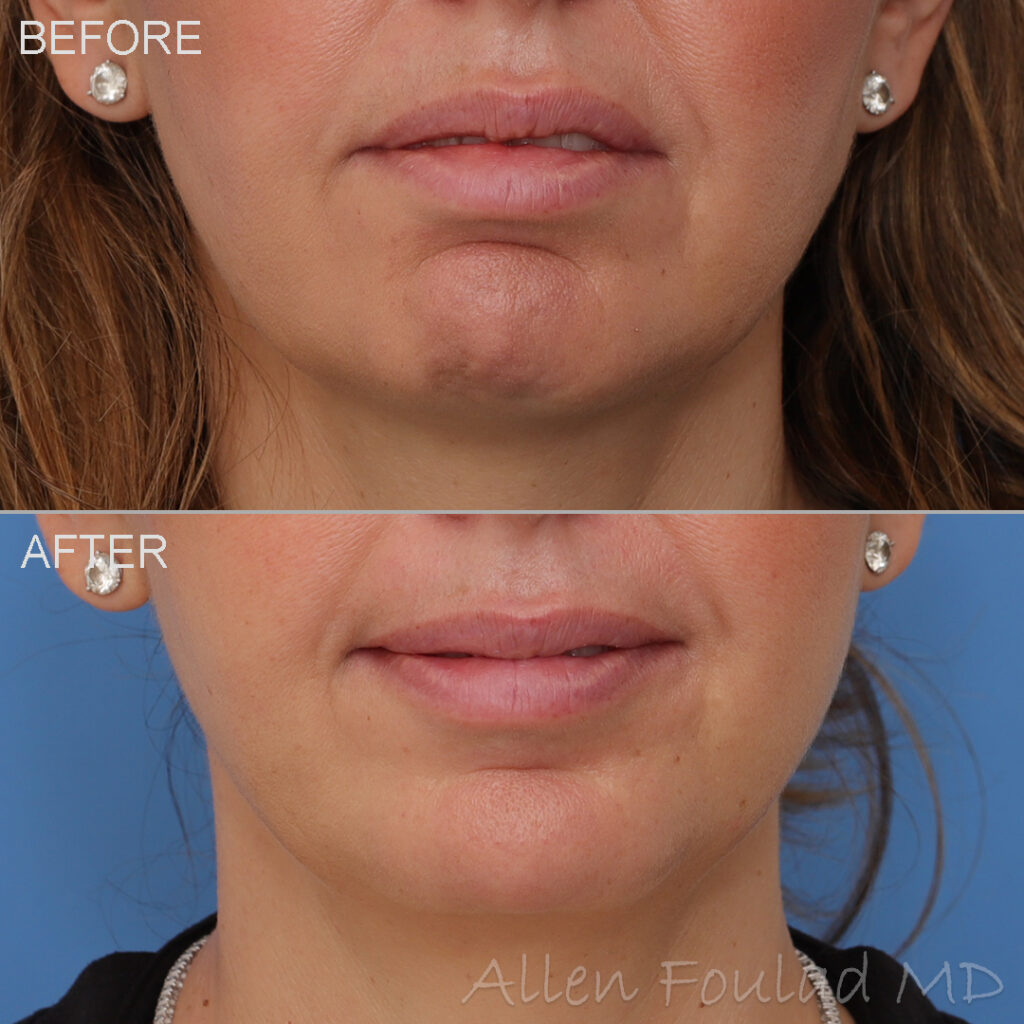 Before and after Botox treatment to relax the mentalis muscle, which improves chin contour and reduces dimpling.