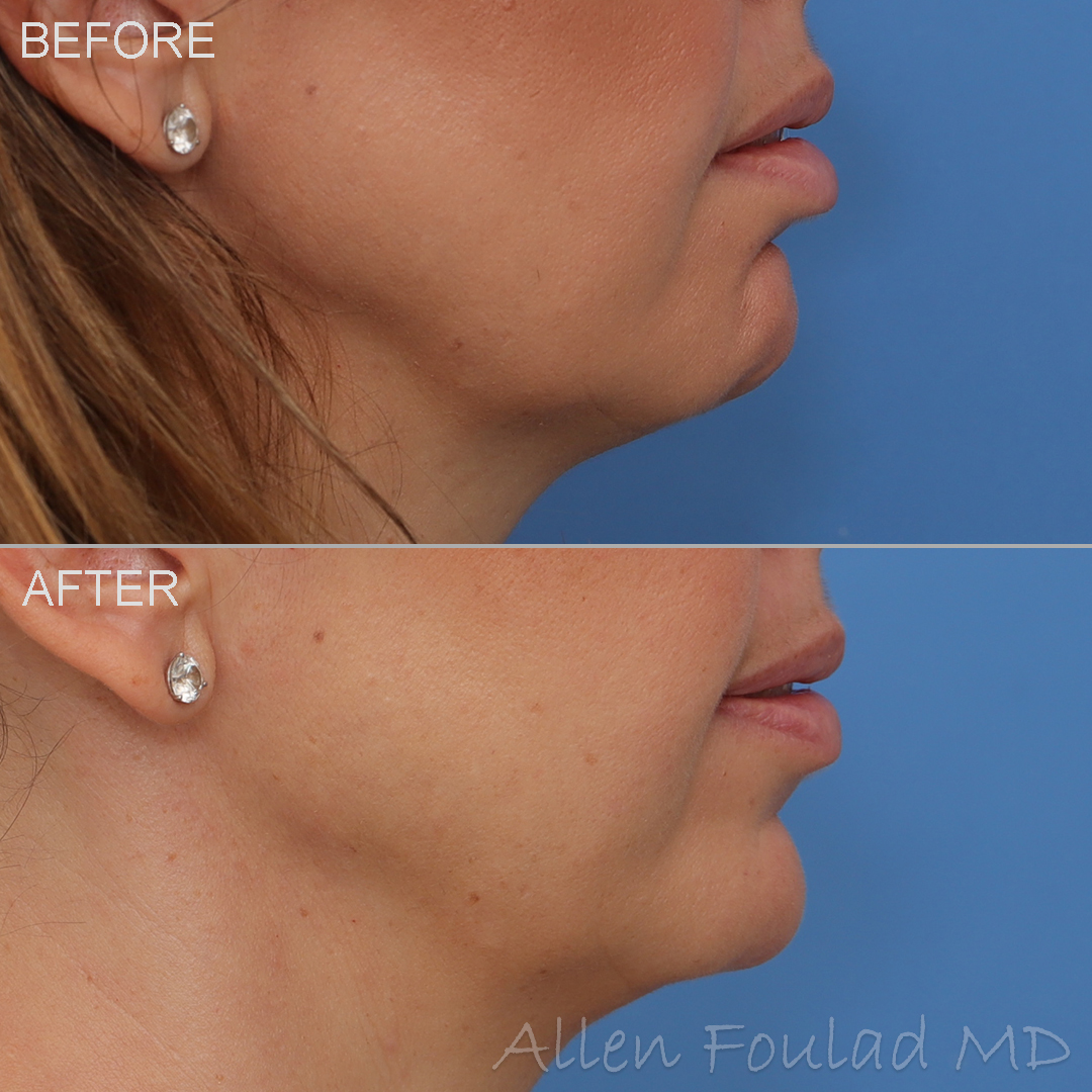 Before and after Botox treatment to relax the mentalis muscle, which improves chin contour and reduces dimpling.