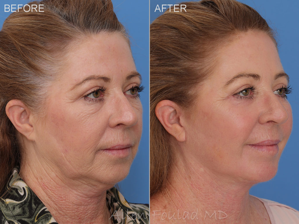 Before and after lower facelift and neck lift. Jawline improved and loose skin lifted.