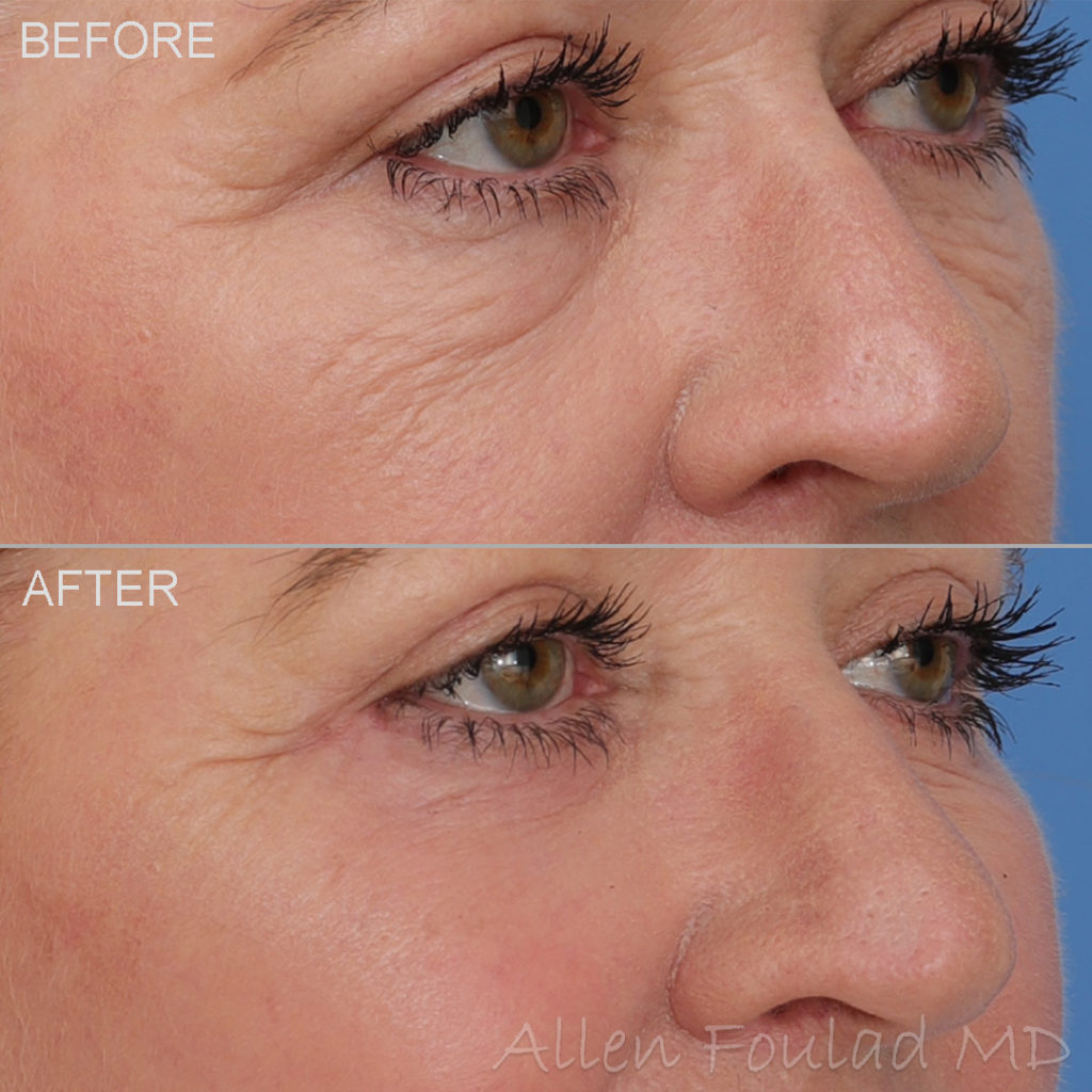 Before and after lower eyelid lift surgery. Reduced fat bags and tightened skin.