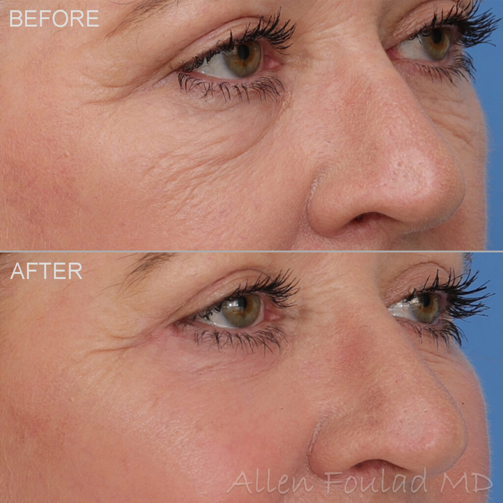 Before & After (id-1006) – Lower Eyelid Blepharoplasty Before and after lower eyelid lift surgery. Reduced fat bags and tightened skin.
