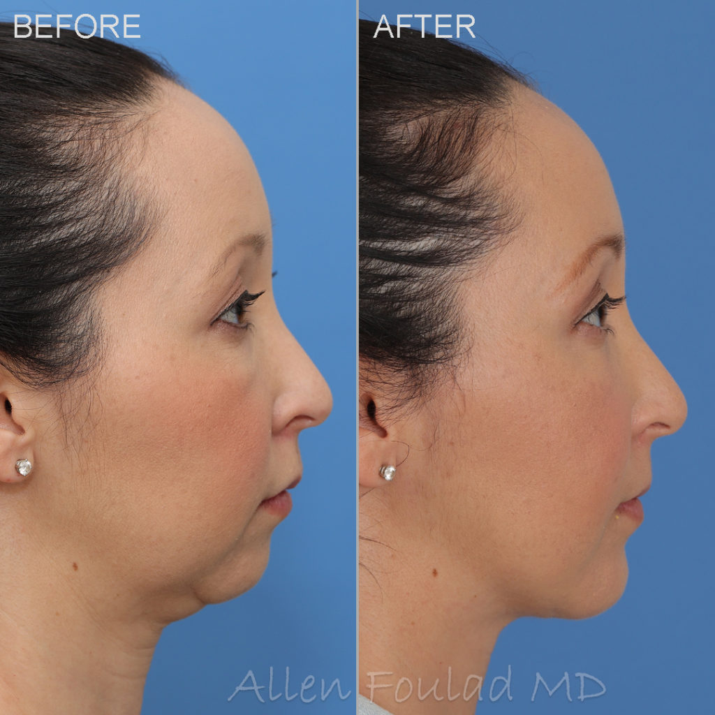 Before and after chin augmentation using a Mittelman Pre Jowl size small implant with wings on female patient.