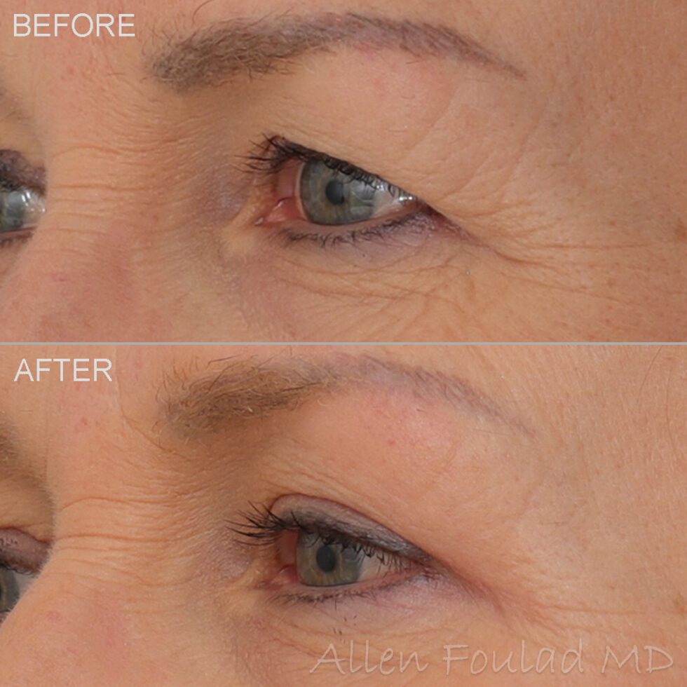 Upper Eyelid Blepharoplasty in Beverly Hills | Allen Foulad MD