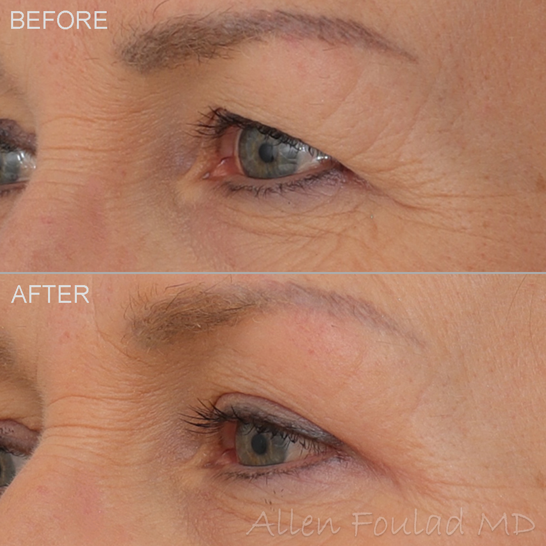 Before and after upper eyelid lift surgery. Reduced eyelid hooding.