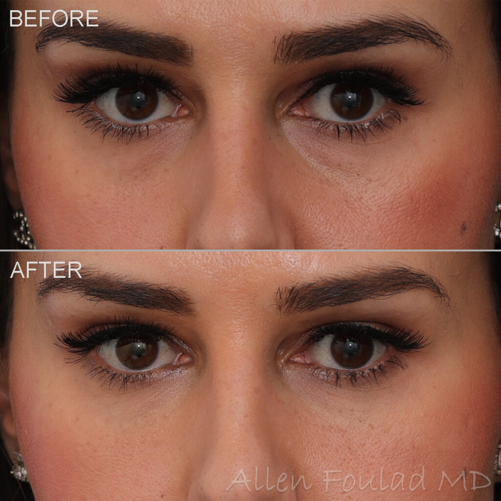 Before & After (id-1015) – Fillers (Under Eye) Before and after tear trough filler treatment. Contour of the under eye region is improved.