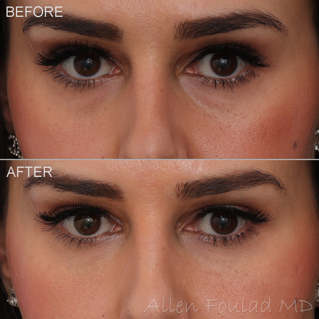 Under Eye Filler Before and After Photo by Allen Foulad MD in Beverly Hills, CA