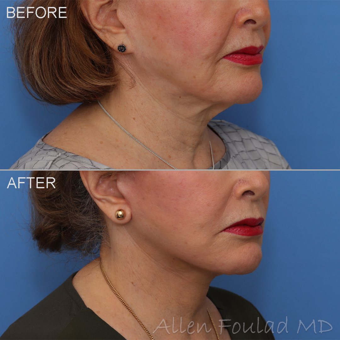 Before and after revision facelift and neck lift. Jowls lifted and neck skin laxity tightened.