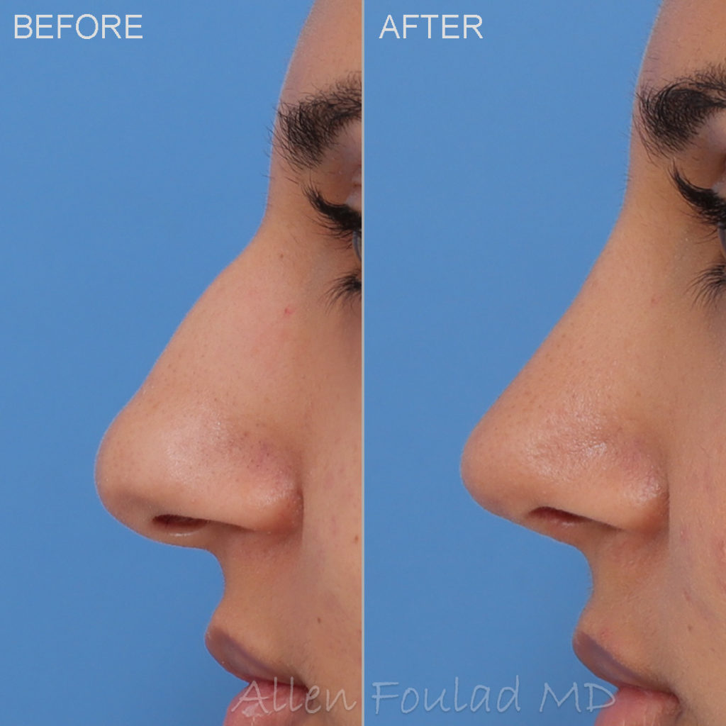Before and after primary rhinoplasty. Nasal tip refined and hump removed.