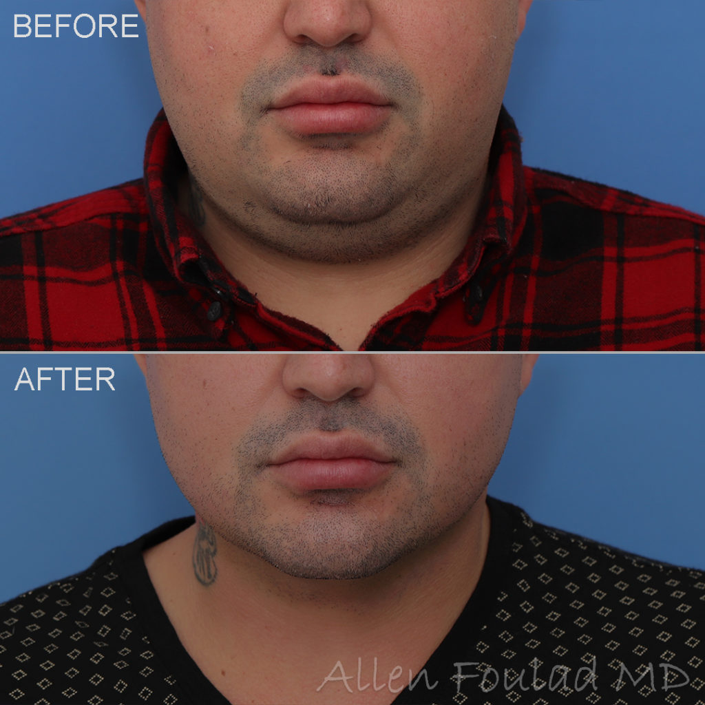 Neck liposuction before and after. Male double chin reduction.