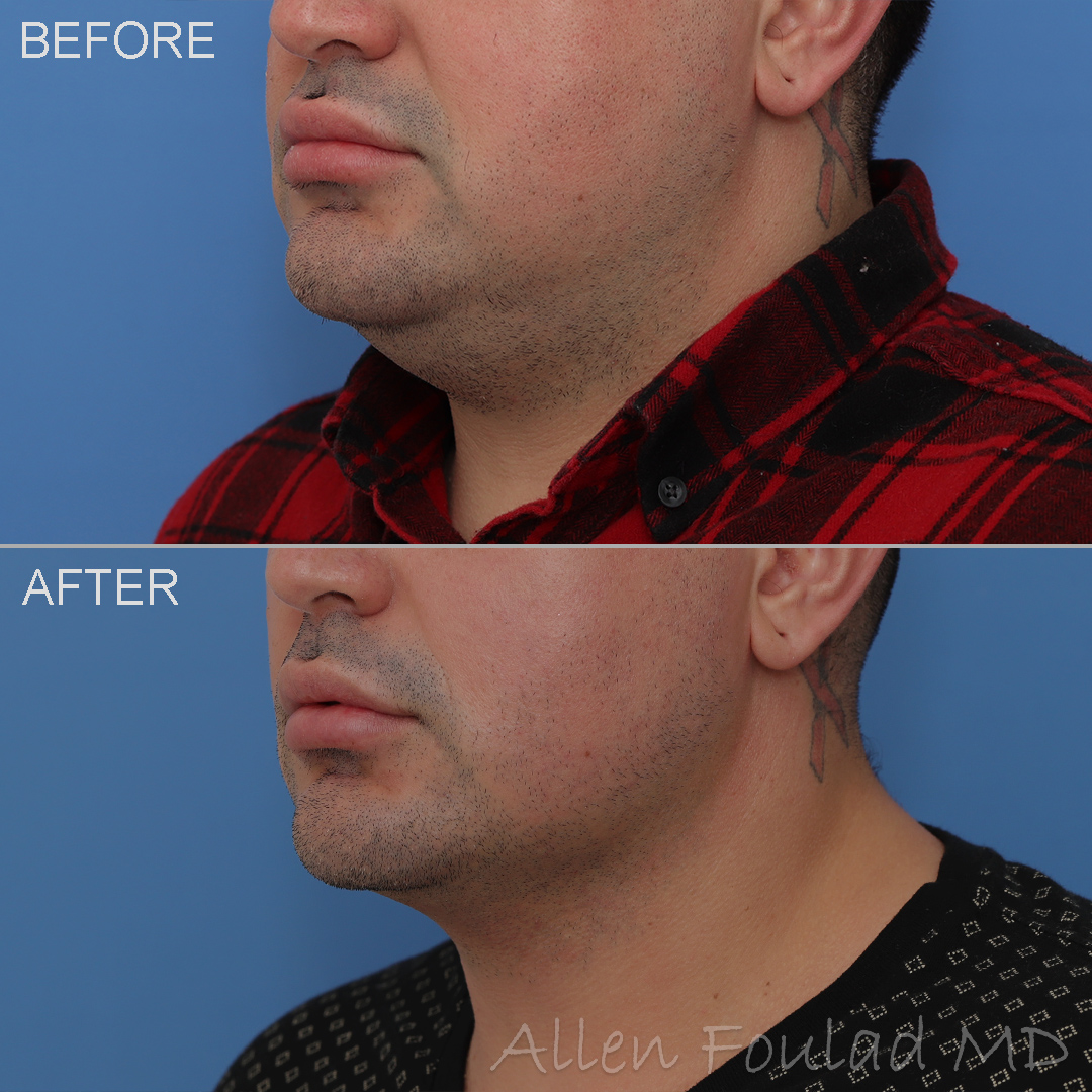 Liposuction - Neck & Face, Buccal Fat Reduction Before and After Photo by Allen Foulad MD in Beverly Hills, CA
