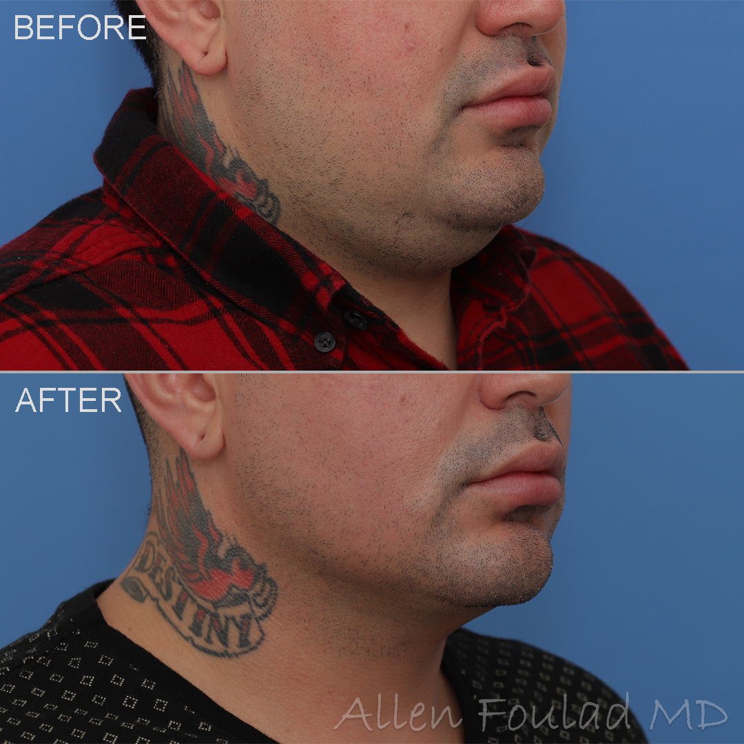 Liposuction - Neck & Face, Buccal Fat Reduction Before and After Photo by Allen Foulad MD in Beverly Hills, CA