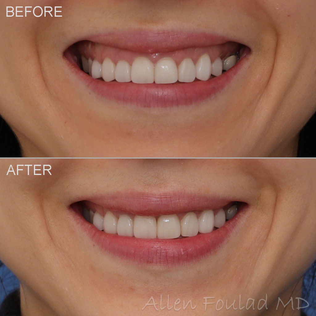 Before and after Botox treatment of excessive gingival display.