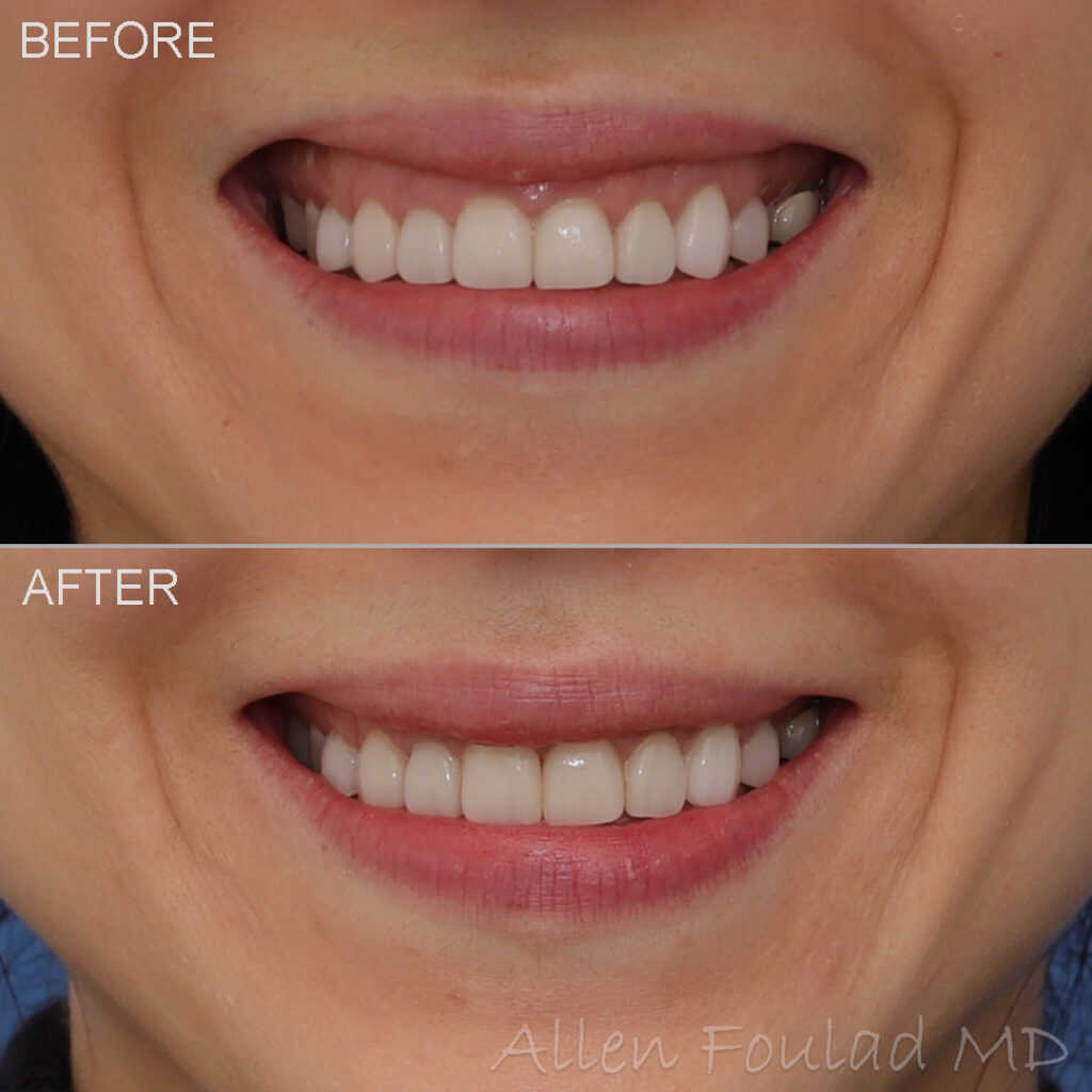 Before & After (id-1009) – Neuromodulators (Gummy Smile Botox) Before and after Botox treatment of excessive gingival display.