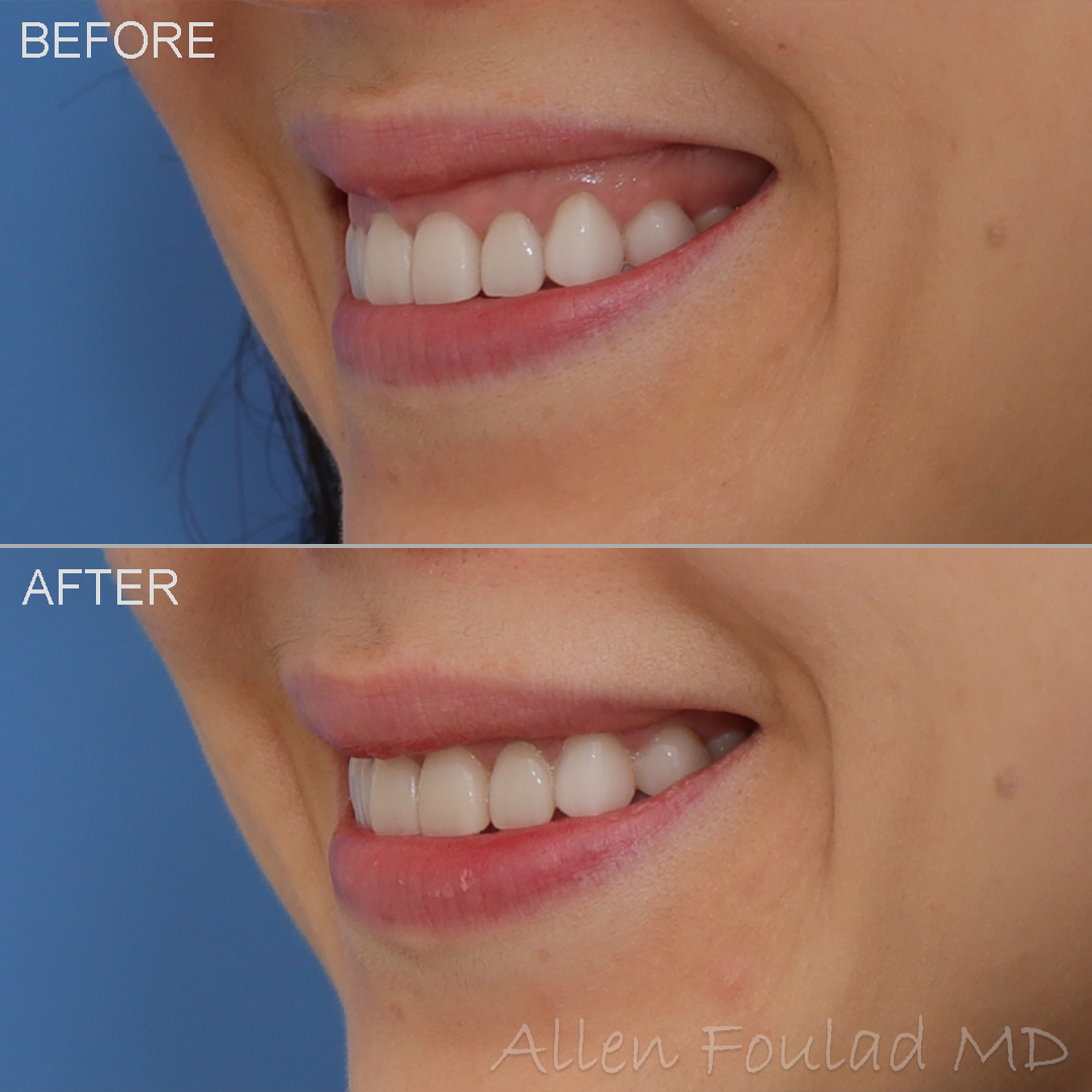 Before and after Botox treatment of gummy smile.