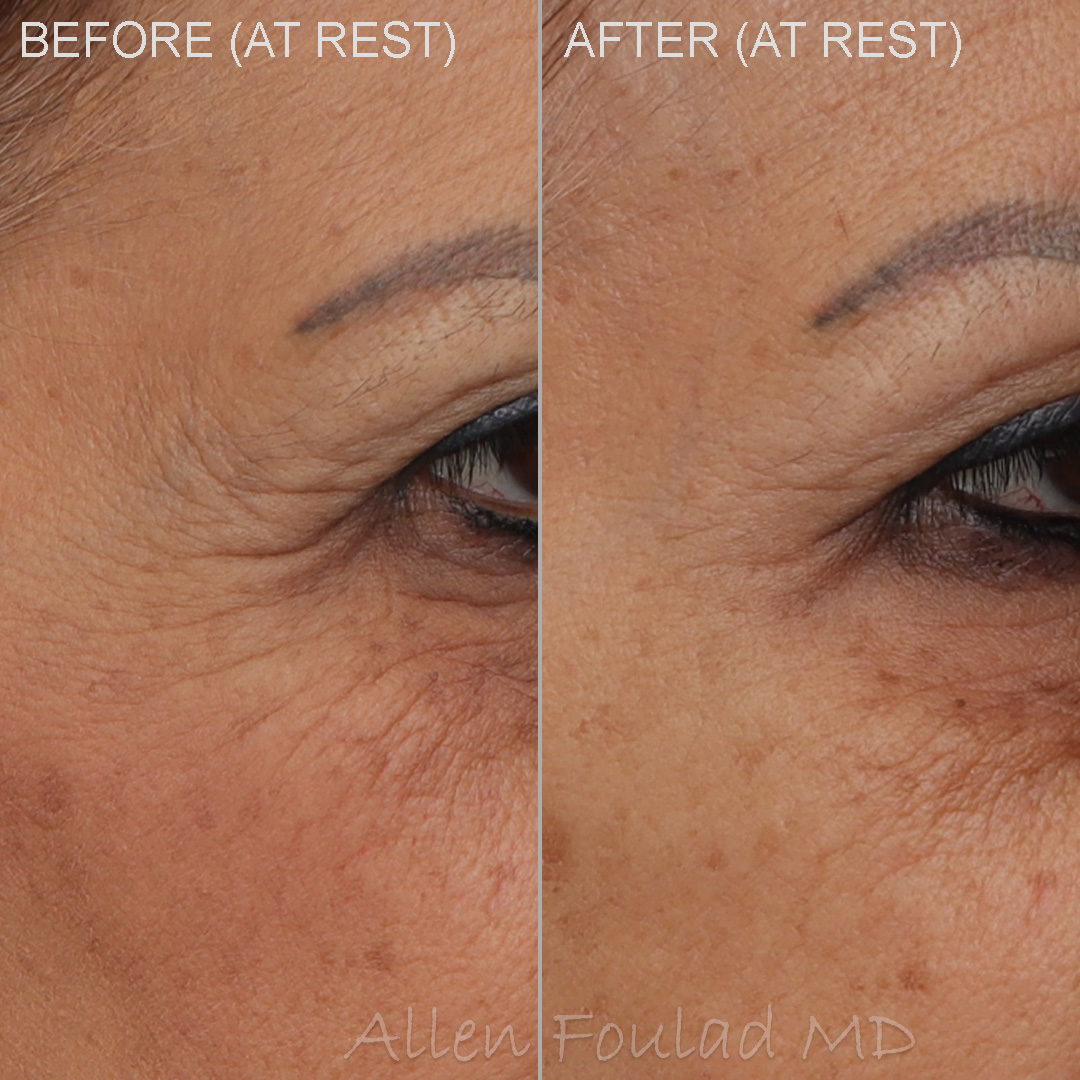Before and after Botox treatment to reduce the wrinkles at the side of the eye.