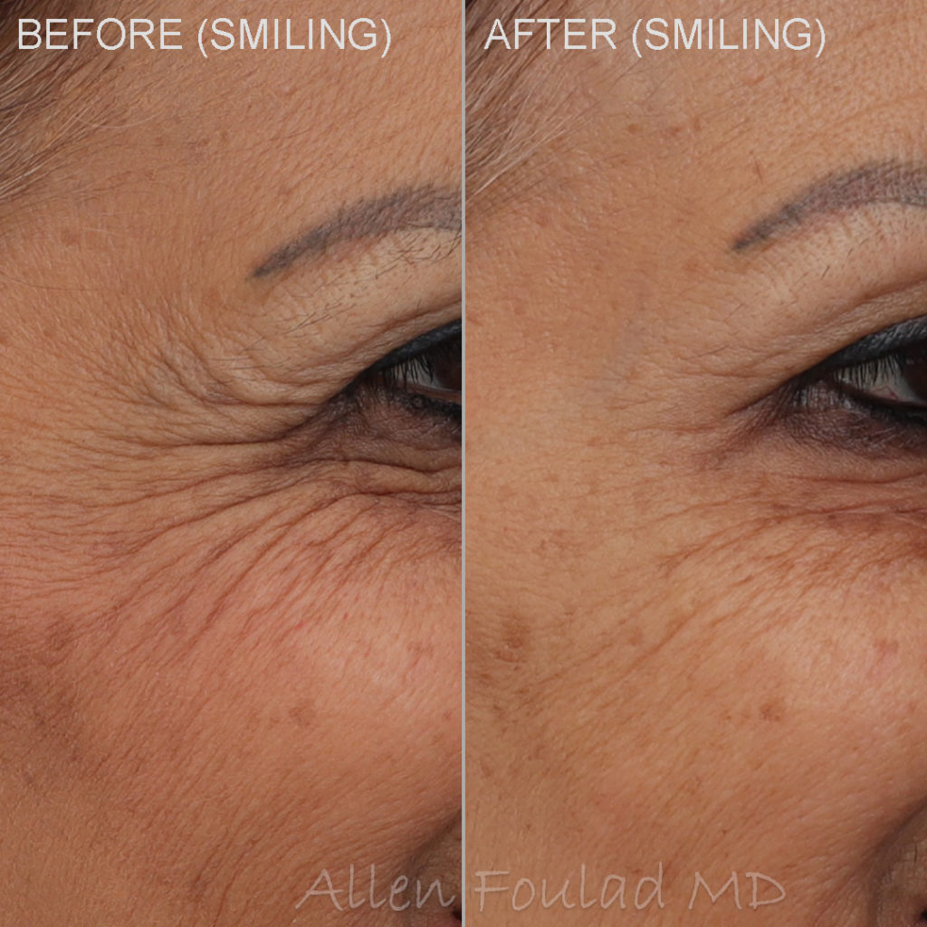 Before and after Botox treatment around the eyes softens the crows feet.