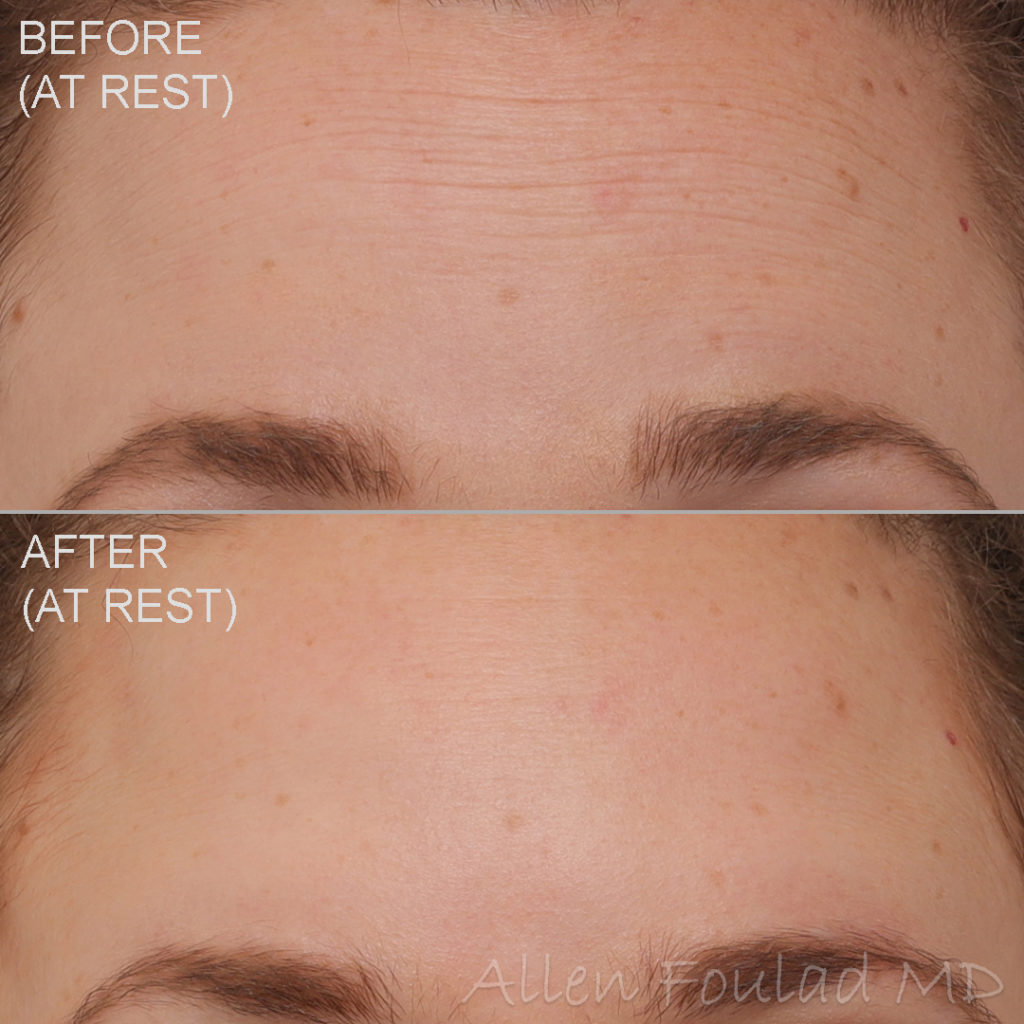 Before and after Botox treatment. Forehead wrinkles are reduced on young woman.