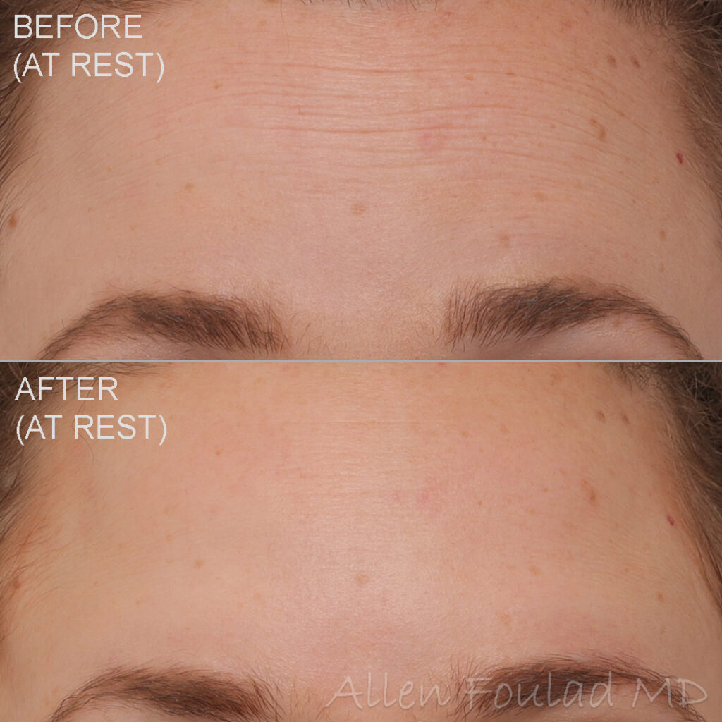 Before & After (id-1018) – Neuromodulators (Forehead Wrinkles Botox) Before and after Botox treatment. Forehead wrinkles are reduced on young woman.