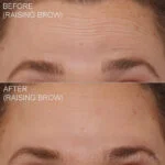 Before & After (id-1018) – Neuromodulators (Forehead Wrinkles Botox)