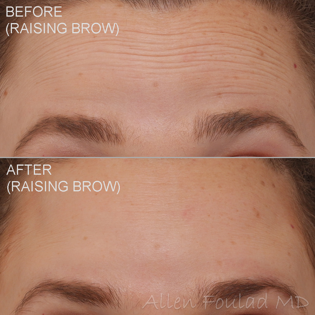 Before and after Botox treatment. Forehead wrinkles are reduced on young woman.