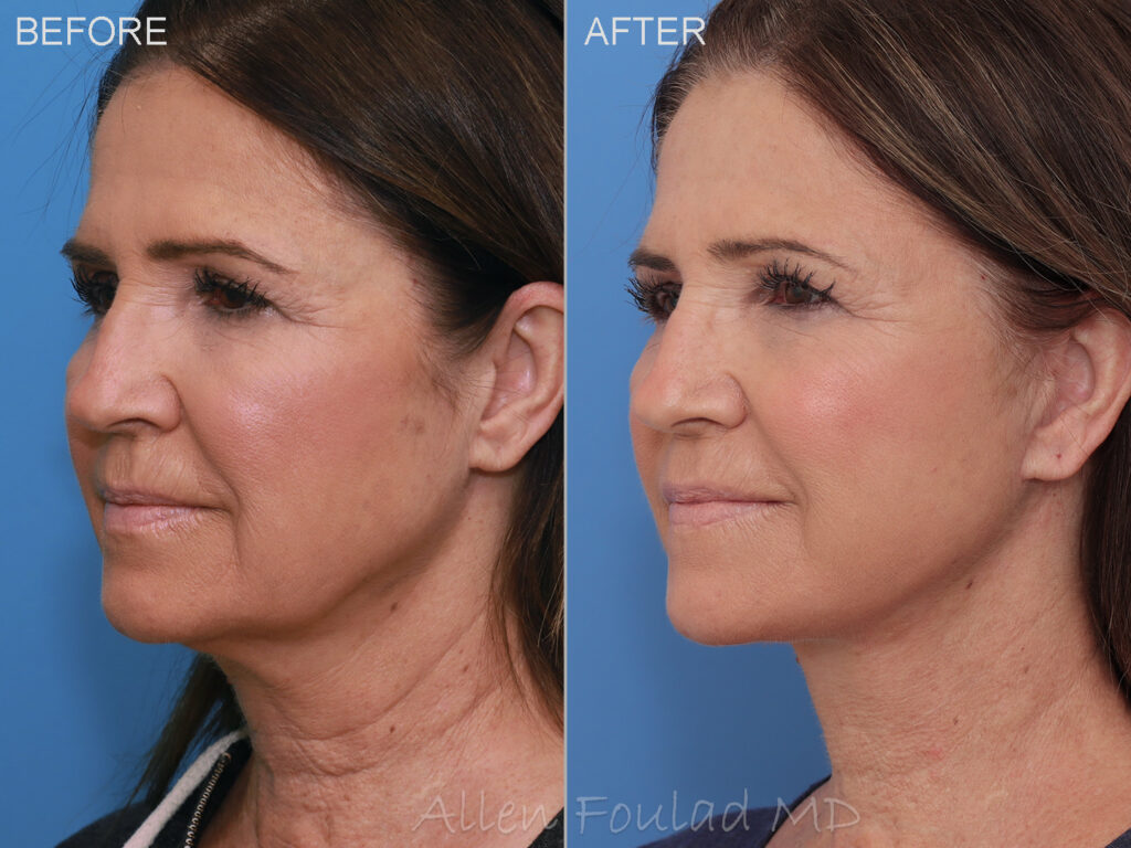 Before and after lower facelift and neck lift. Jowls lifted and loose neck tissues tightened.