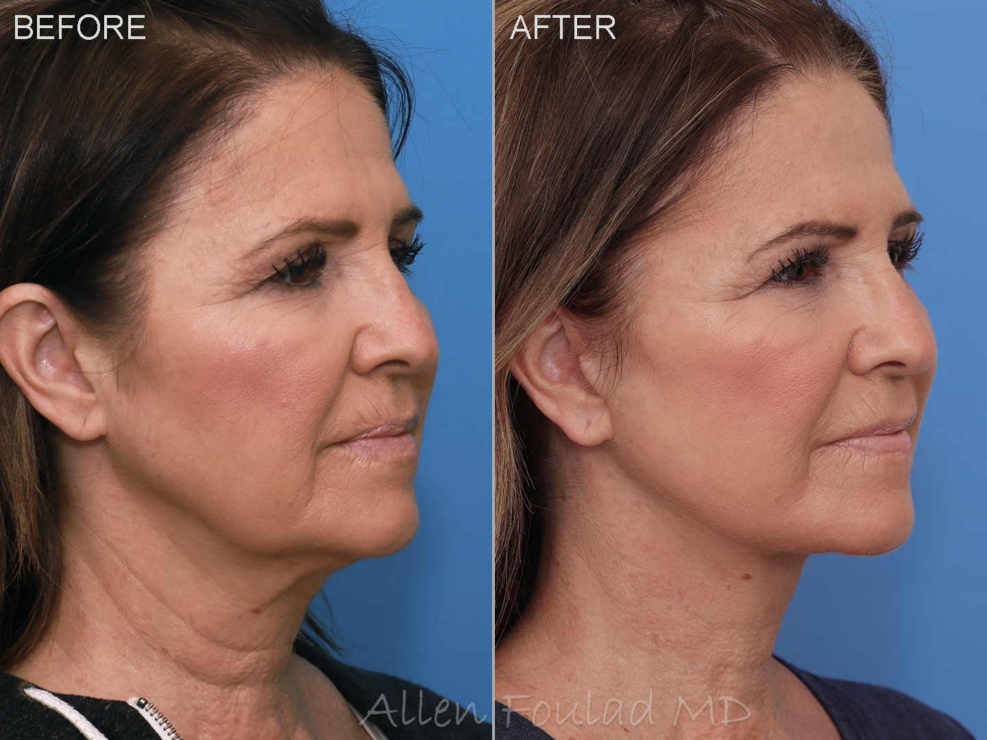 Before and after lower facelift and neck lift. Jowls lifted and loose neck tissues tightened.