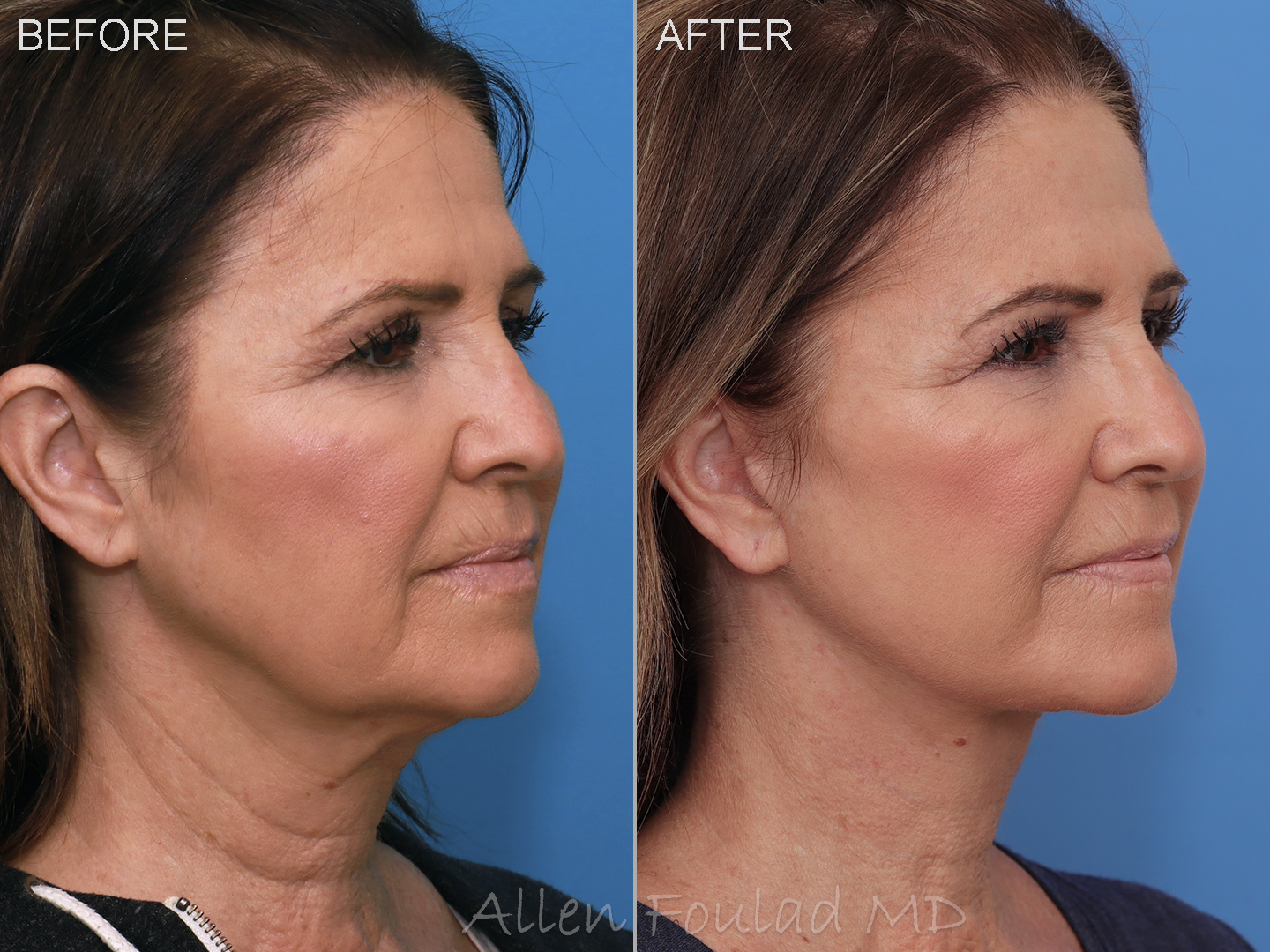 Facelift & Neck Lift Before and After Photo by Allen Foulad MD in Beverly Hills, CA