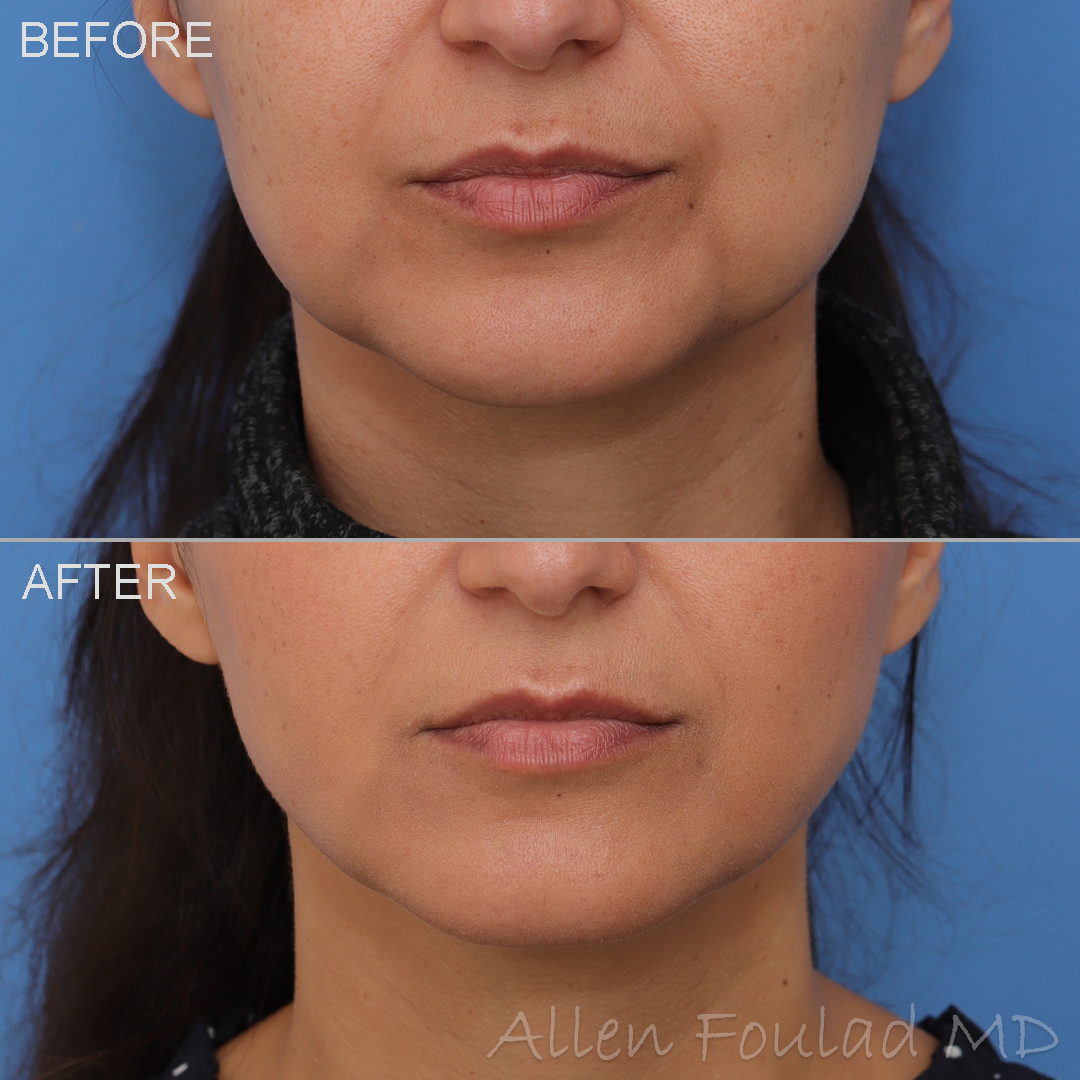 Neck Liposuction & Buccal Fat Reduction Before and After Photo by Allen Foulad MD in Beverly Hills, CA