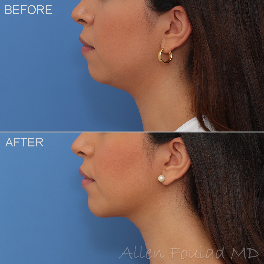 Neck Liposuction & Chin Implant Before and After Photo by Allen Foulad MD in Beverly Hills, CA