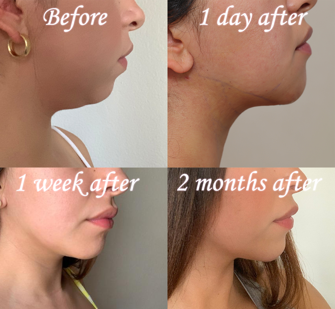 Chin implant on young female patient. Selfie timeline of healing 1 day after, 1 week after, and 2 months after the procedure.
