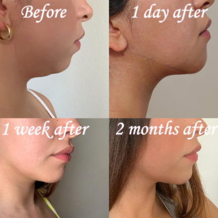 Neck (submental) liposuction female patient showing healing over time at 1 day after, 1 week after, and 2 months after the procedure.
