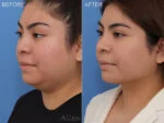 Before & After (id-1028) – Liposuction of Neck & Face