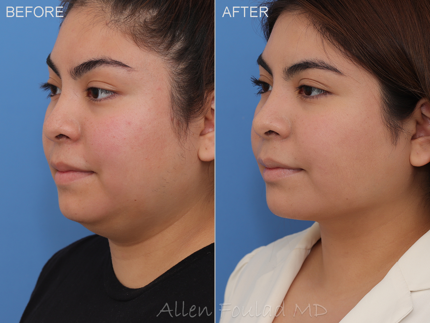 Before and after neck and lower face liposuction and buccal fat pad reduction in young woman. Jawline definition improved and double chin gone.